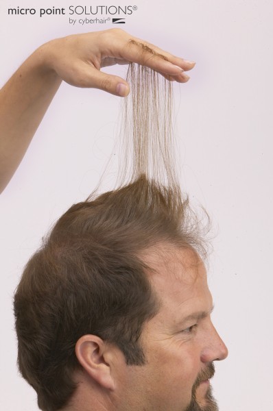 regrow hair in temple area